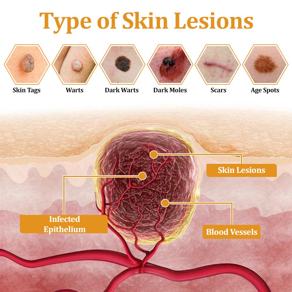 🐝 flysmus™ TagCure Bee Venom Skincare Cream, Certified by The British Association of Dermatologists (BAD) – Helps Treat Persistent Warts, Skin Tags, Skin Lesions, Infections, Scarring, and Smooth Uneven Skin 🌿👨⚕️